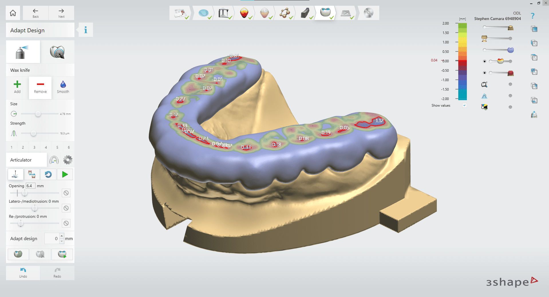 How 3D Printing is Revolutionizing Nightguards and Splints ODL