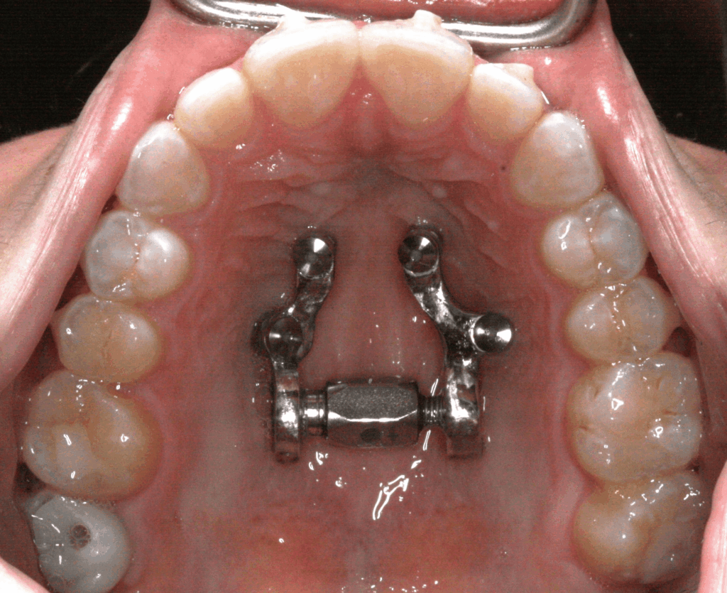 Maspe Machine MASPE Zero: Miniscrew-Assisted Skeletal Expander | ODL