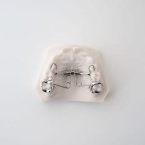 MDA (Mini Distalizing Appliance) 1