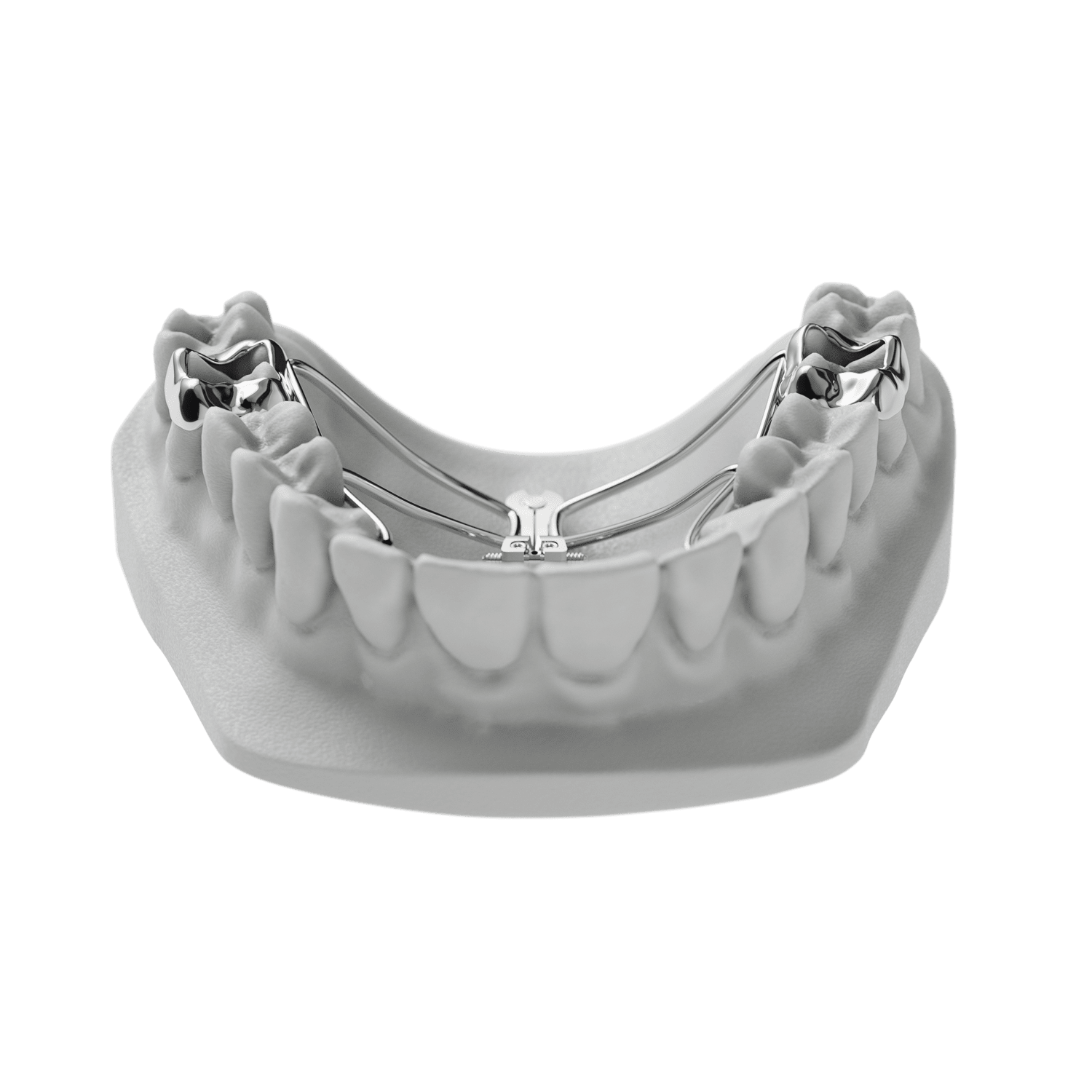 Fan RPE (Rapid Palatal Expander) ODL Orthodontic Labs