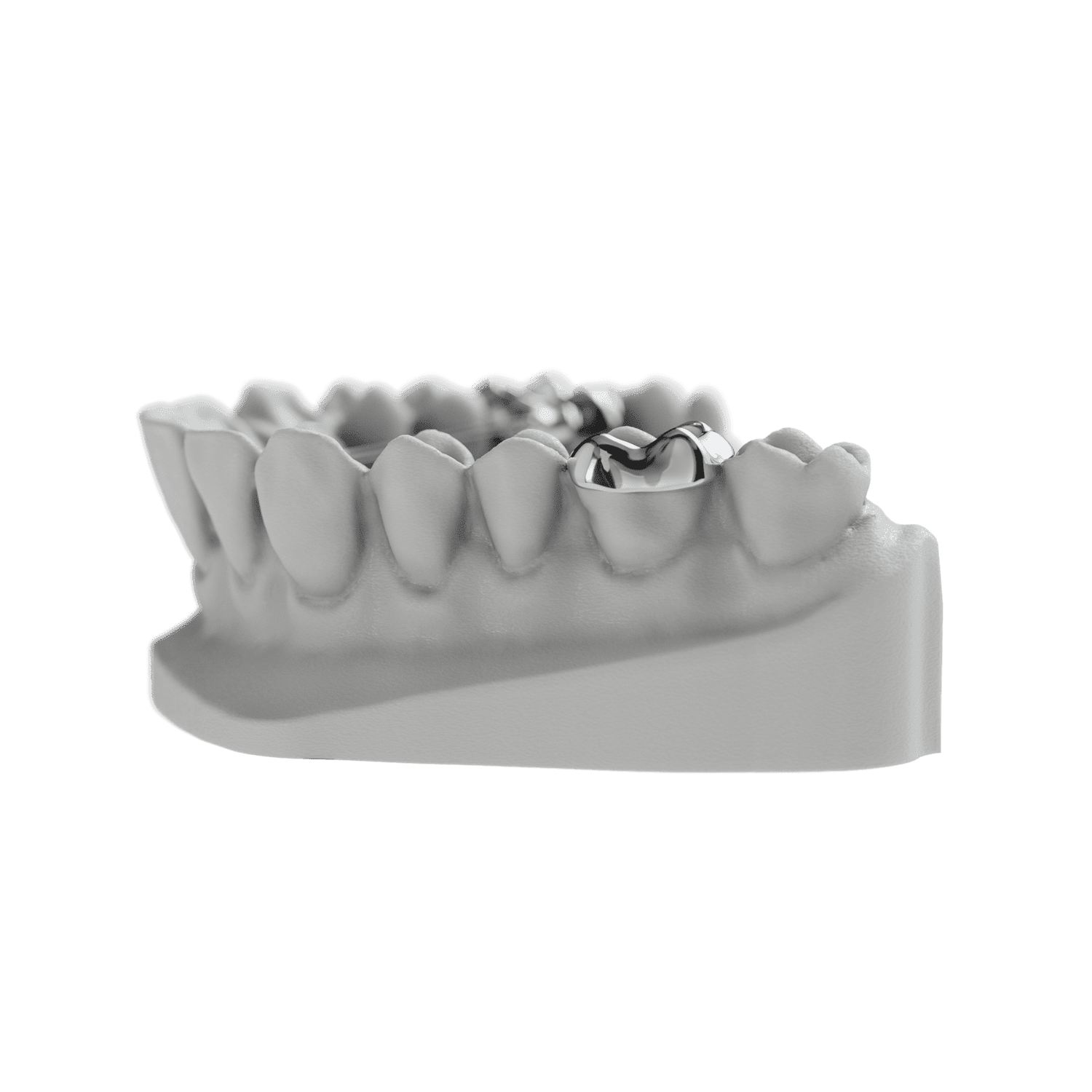 Lower E-Arch (Arnold Expander) | ODL Orthodontic Labs