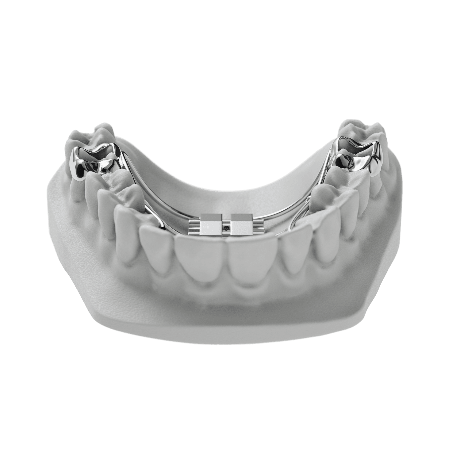 Palatal Expander - Janzen, Janzen & Chwa Orthodontics, Ltd