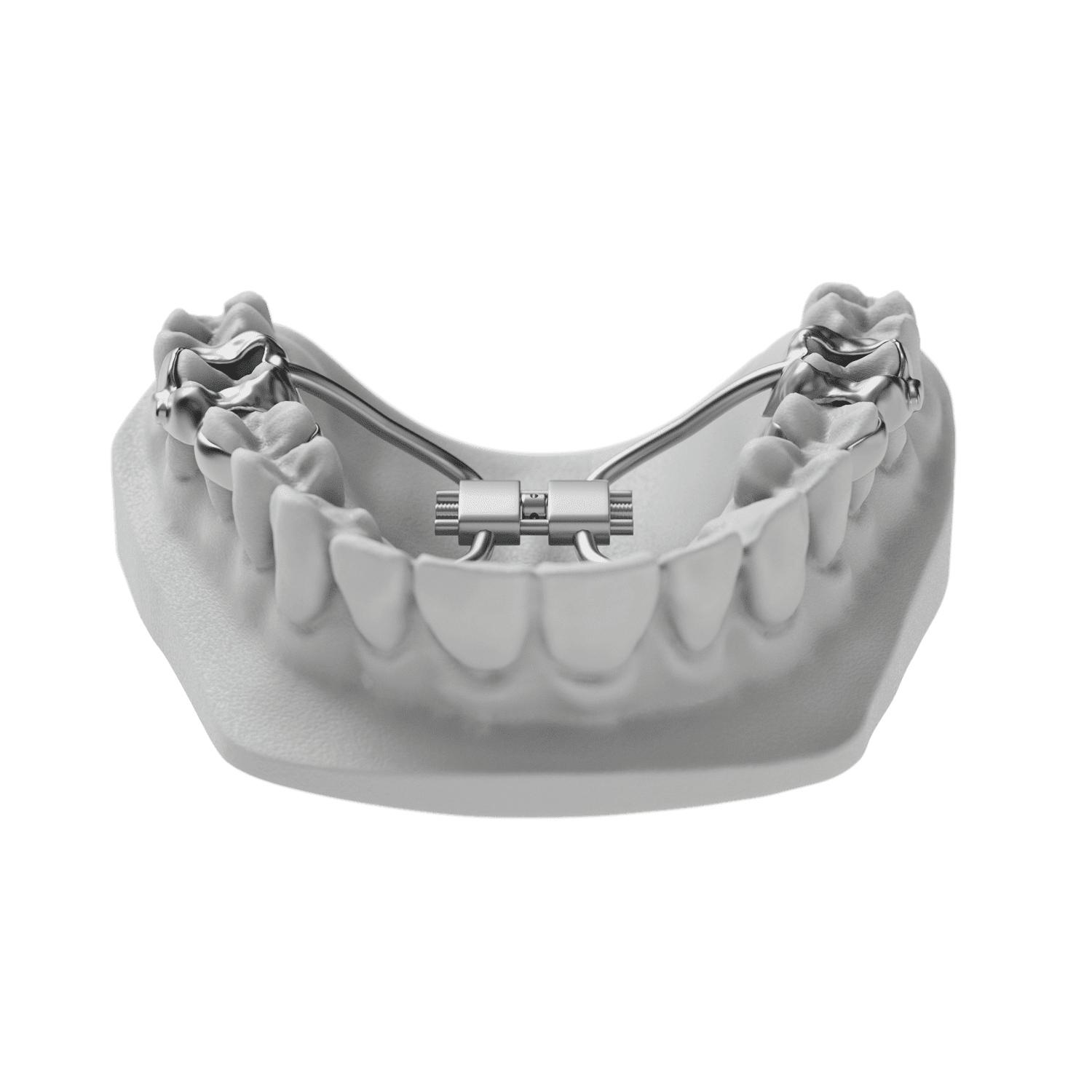 Tomas Tad Expander  ODL Orthodontic Labs