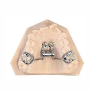 ODL telescopic anatomical cad cam expander 1 sq