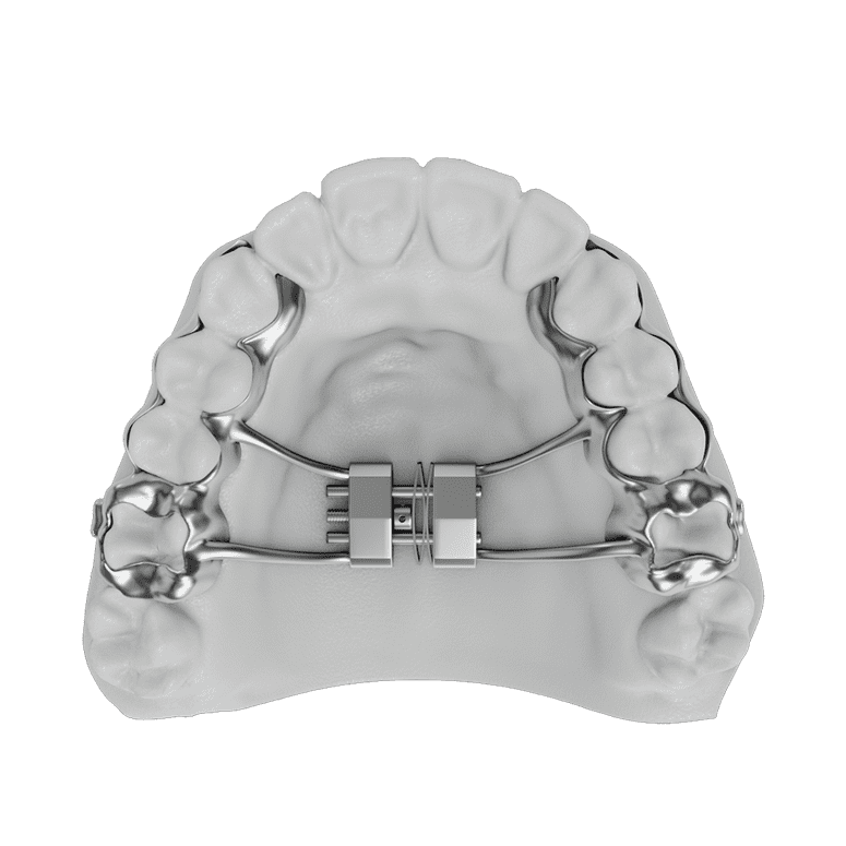 Palatal Expansion  ODL Orthodontic Labs