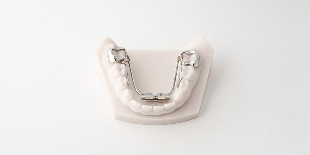 Lower Rapid Palatal Expander (RPE) 3