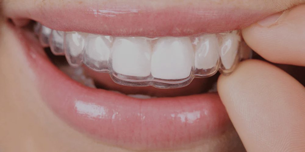 Essix Retainers