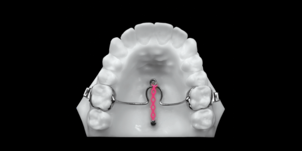Molar Distalization Methods