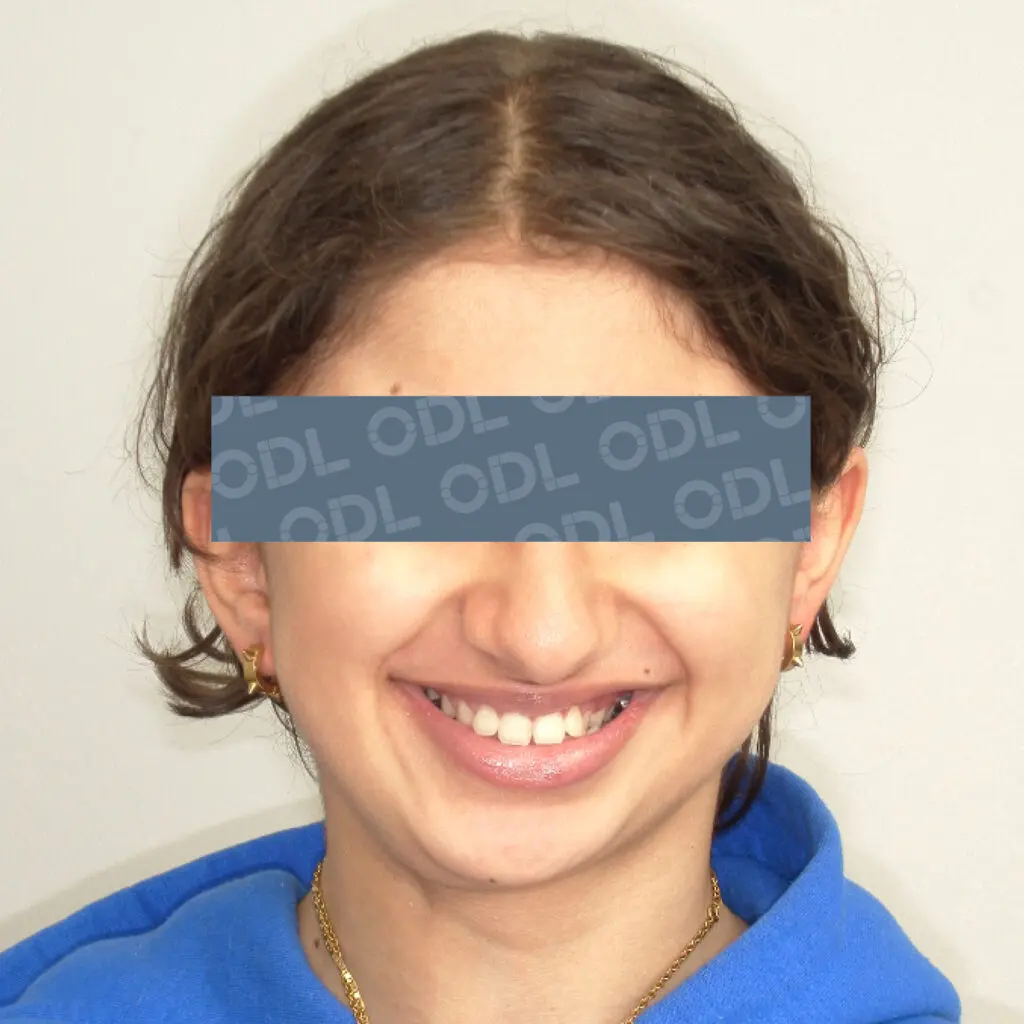 odl casper patient 1 after