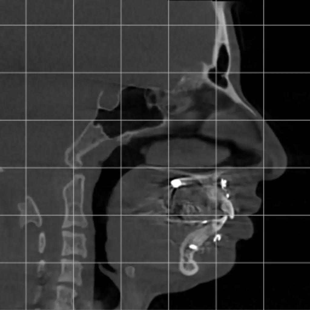 odl casper patient 1 scan after