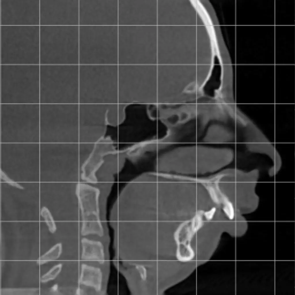 odl casper patient 1 scan before
