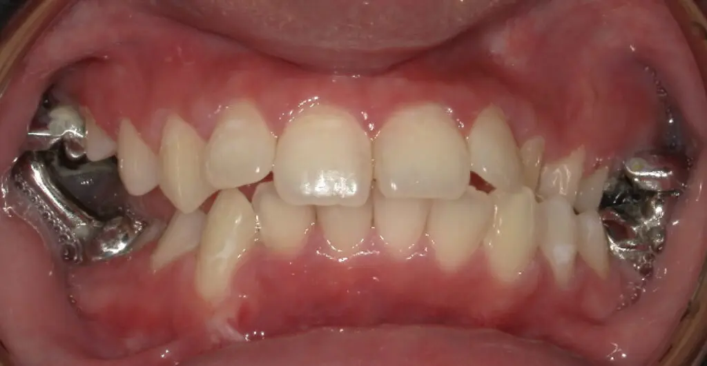 odl casper patient 1 teeth after