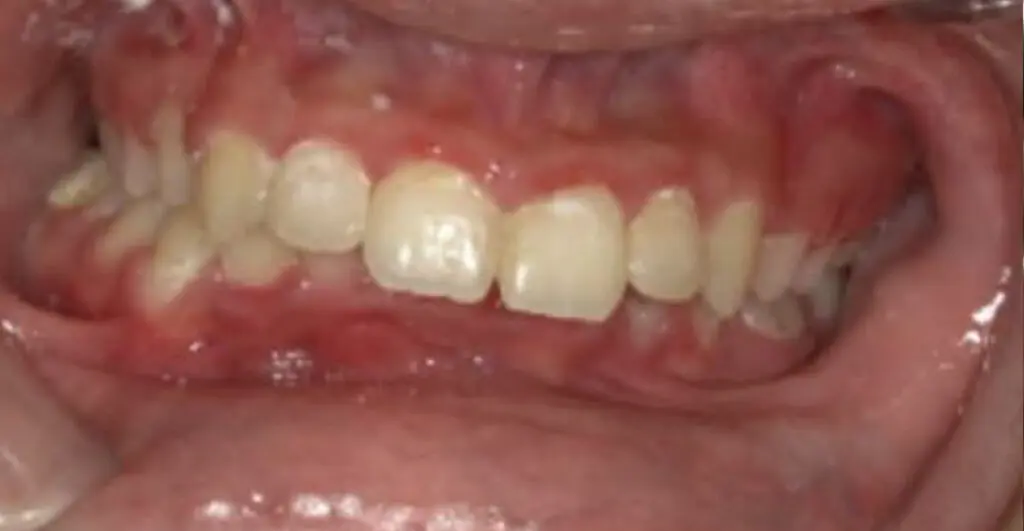 odl casper patient 1 teeth before