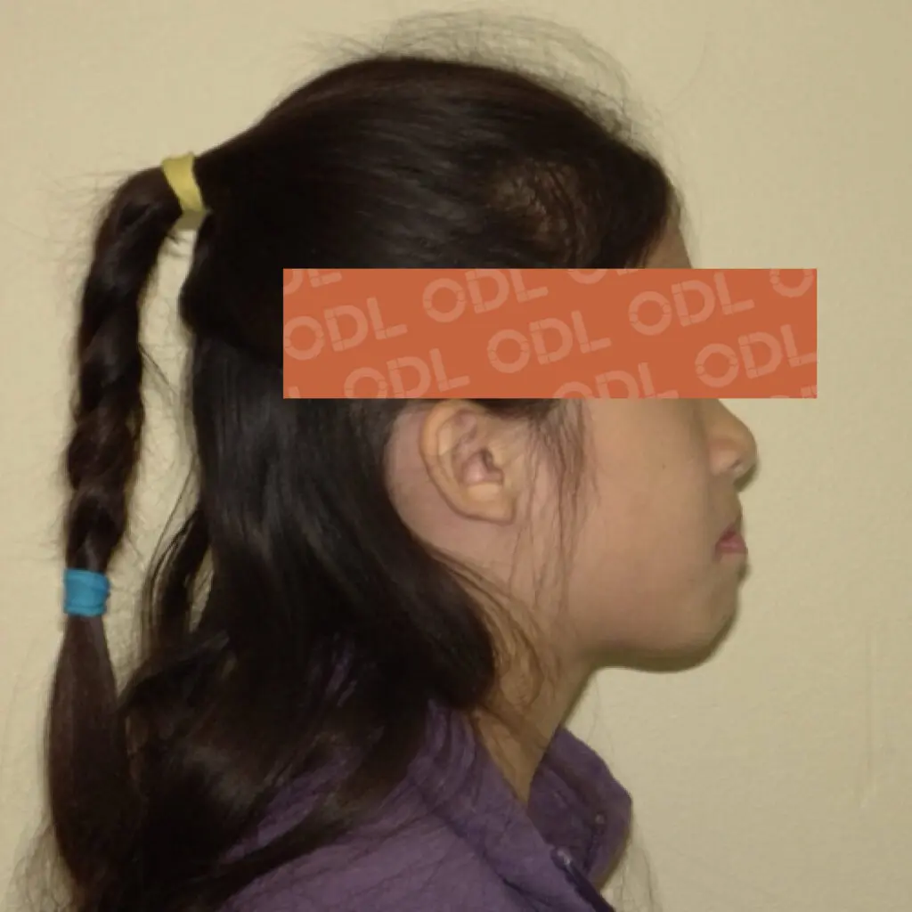 odl casper patient 3 after