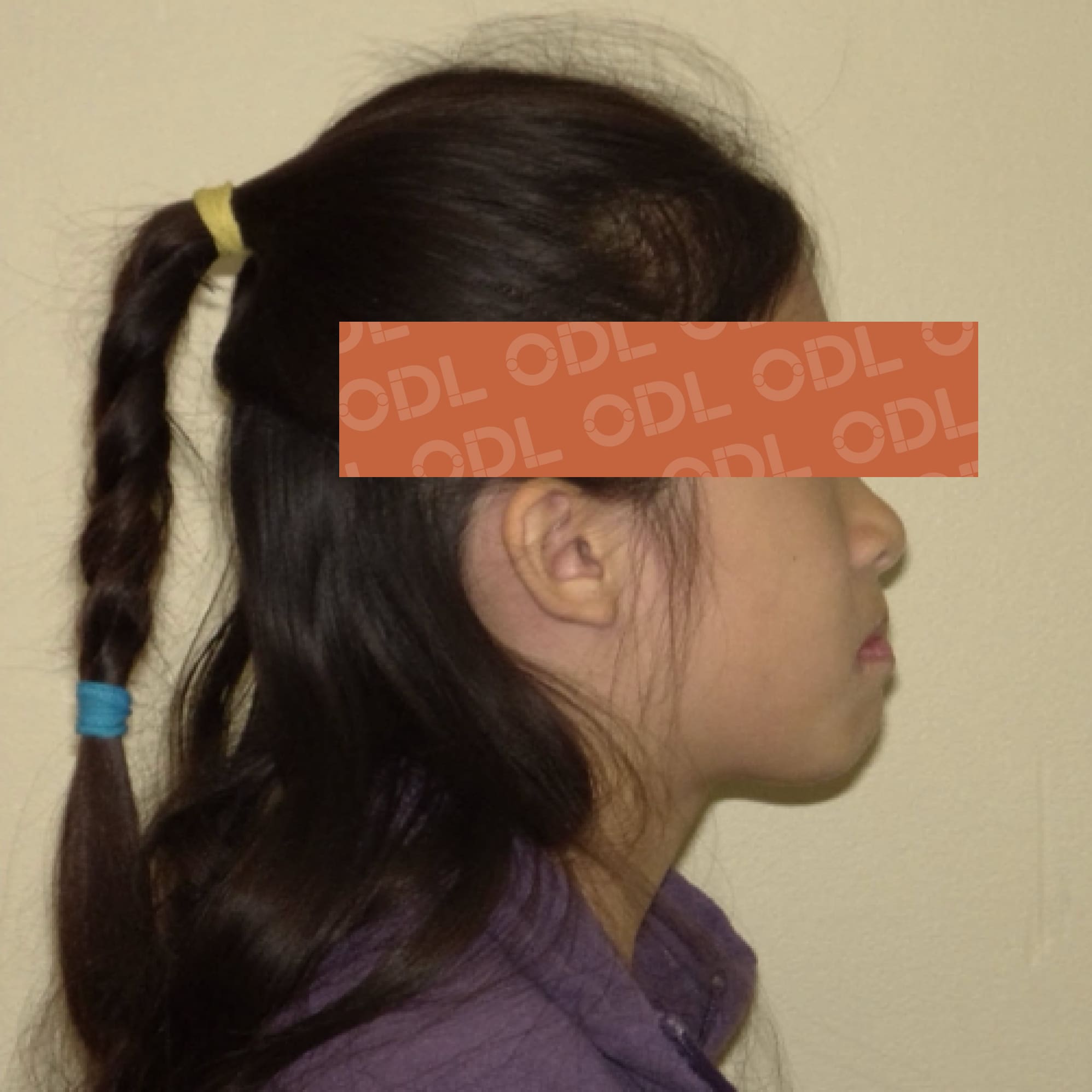 Casper | The Next Generation of Class II Correction | ODL