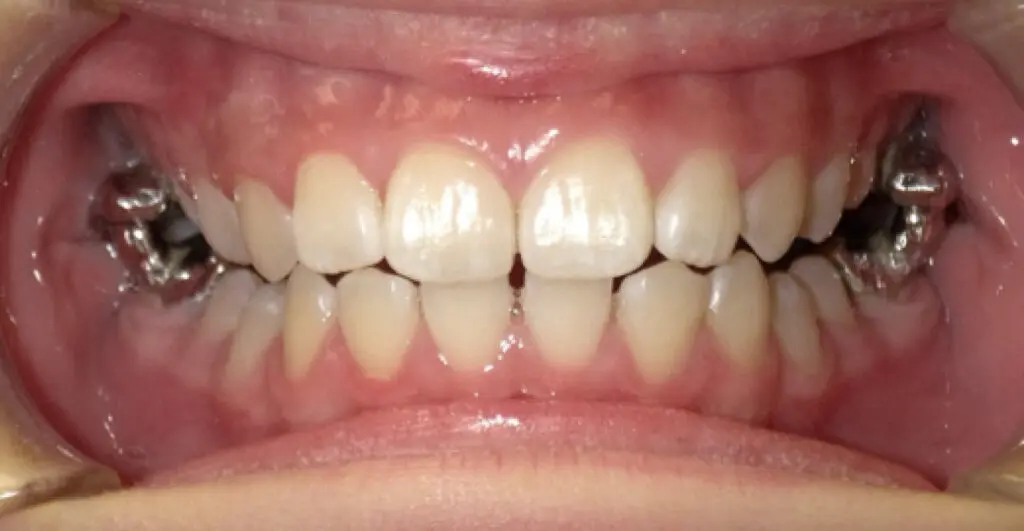 odl casper patient 3 teeth after