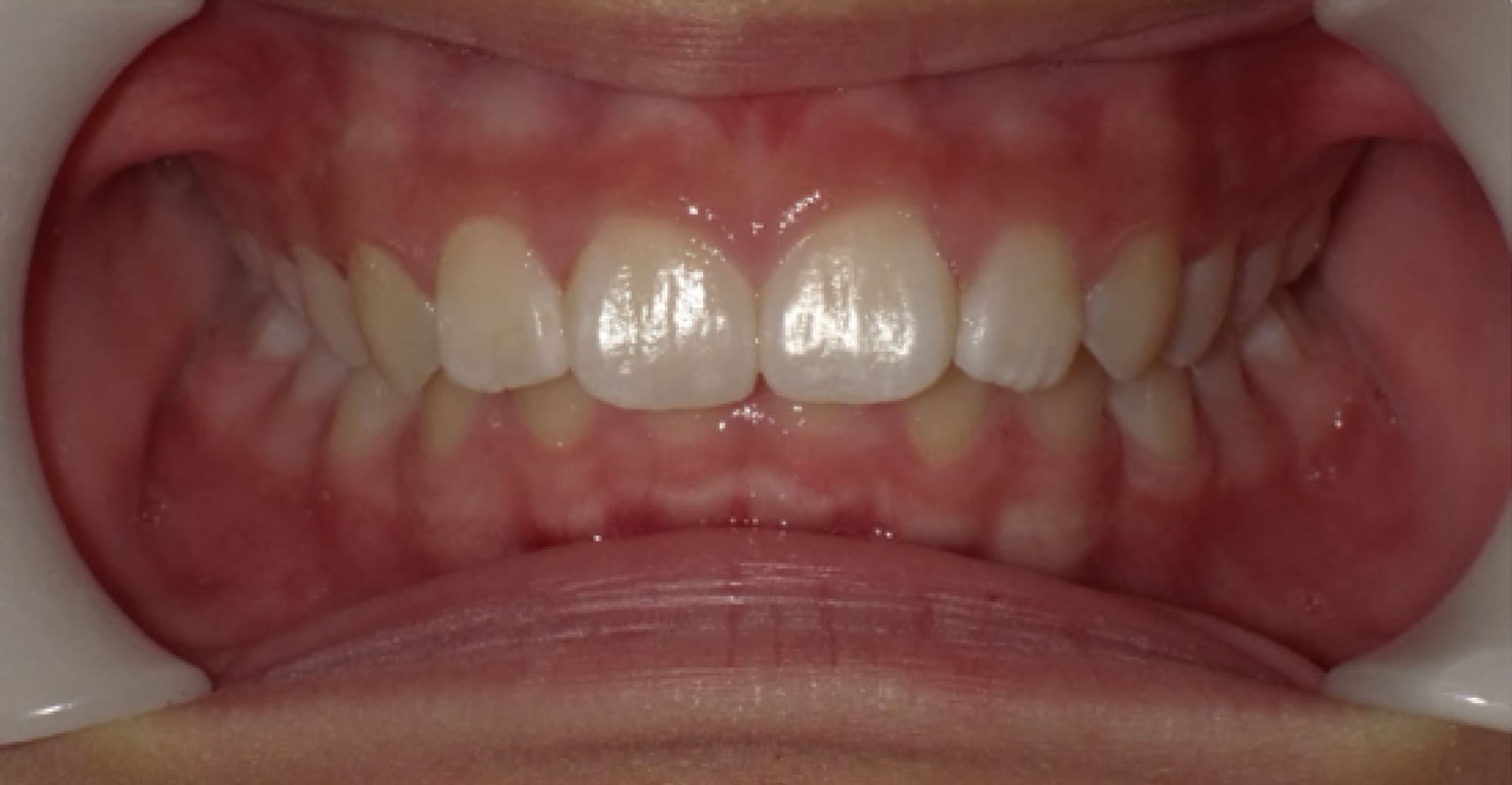 Casper | The Next Generation of Class II Correction | ODL