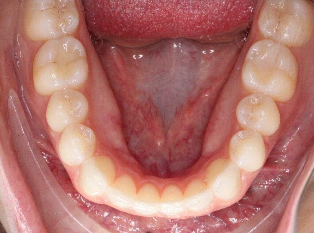 odl vivid lower arch after intraoral photo