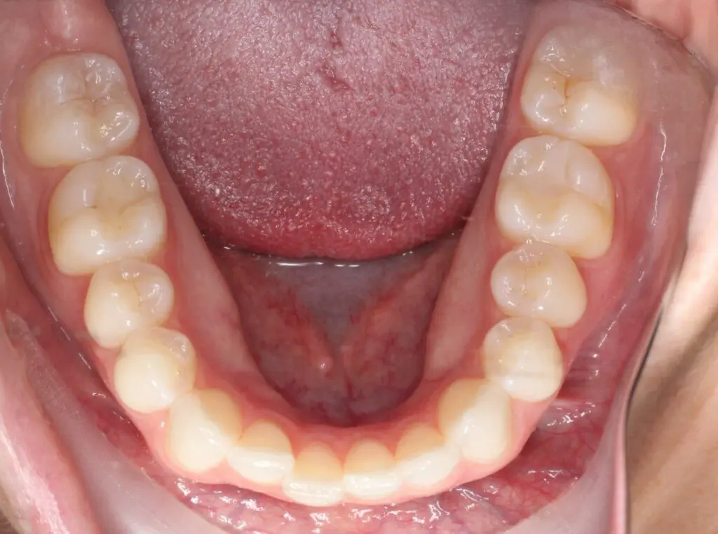 odl vivid lower arch before intraoral photo