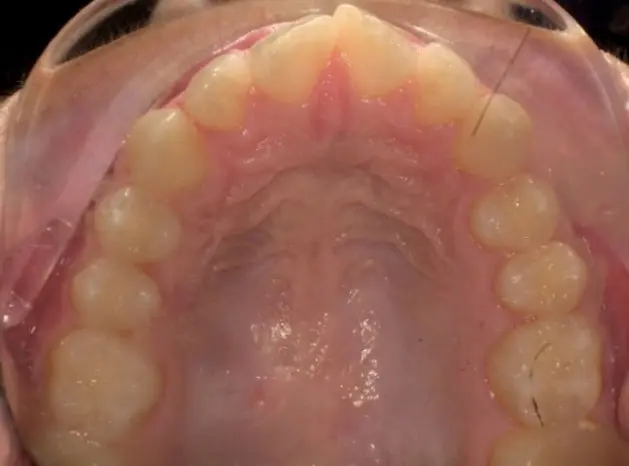 odl vivid patient before photo top